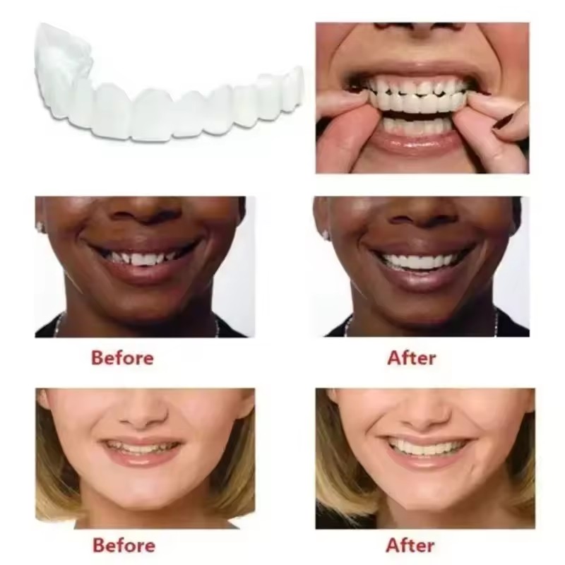 Teeth Veneers Whitening Dentur - Teeth Whitening For Braces ulasan dan harga