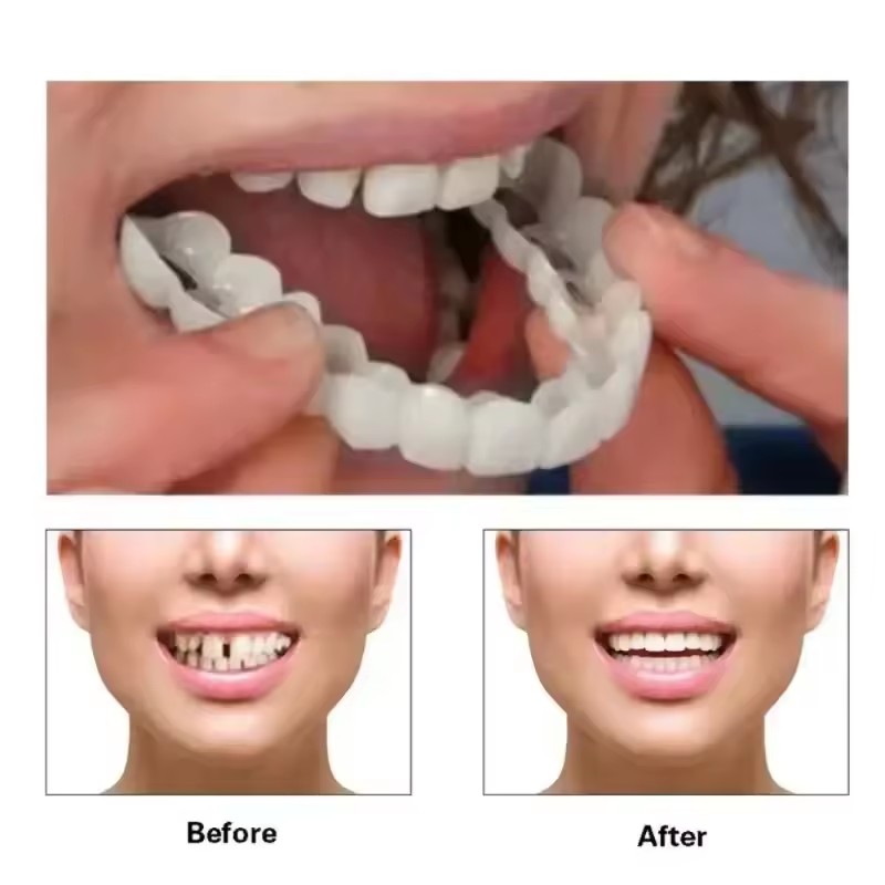 Teeth Veneers Whitening Dentur - Teeth Whitening For Braces ulasan dan harga